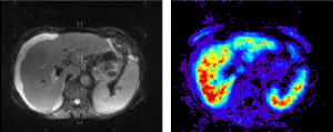 Magnet­Resonanz­Tomographie der menschlichen Leber: herkömmli­ ches Kontrastbild (links) und mit Elastographie detektierte lokale  Steifigkeit (blau­=gering bis rot­=hoch). [Bildquelle: Charité Universitätsmedizin Berlin, Prof. Sack]